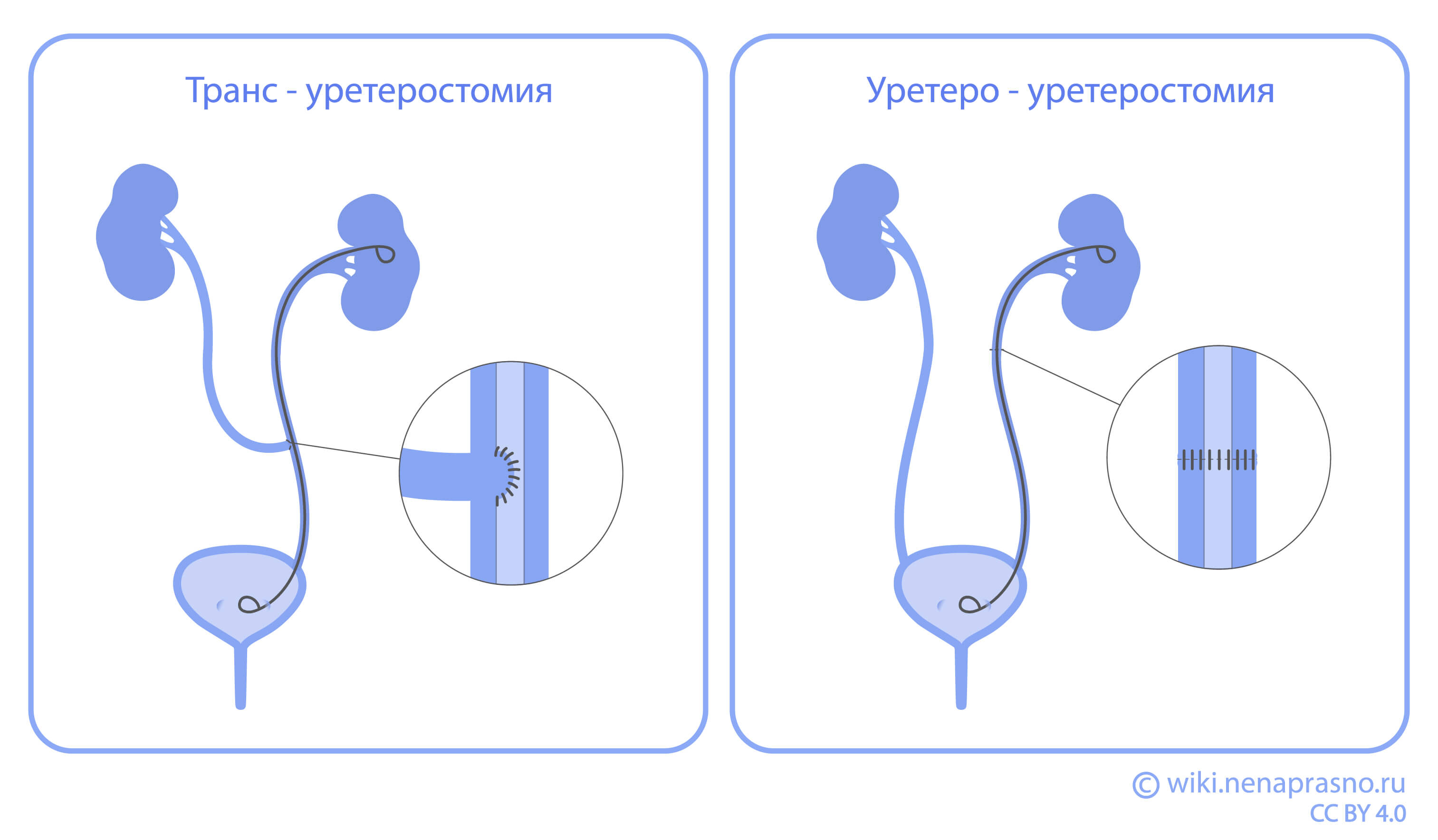 Транс-уретеростомия.jpg