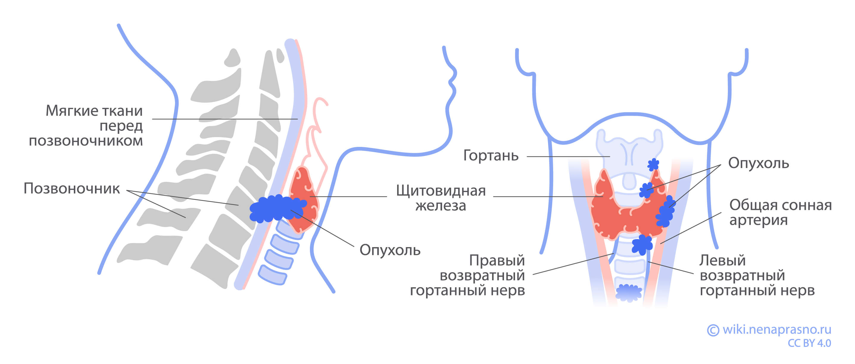 Опухоли щитовидной железы.jpg