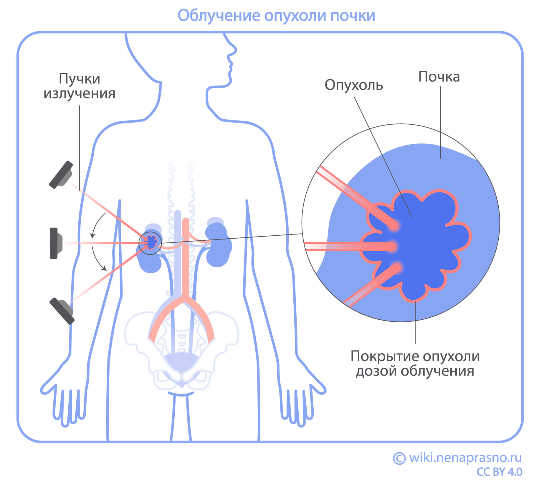 Лапароскопическая нефрэктомия (удаление почки)