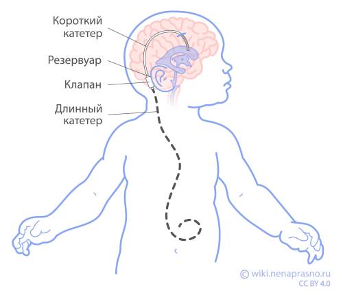 Лечение осложнений опухолей ЦНС