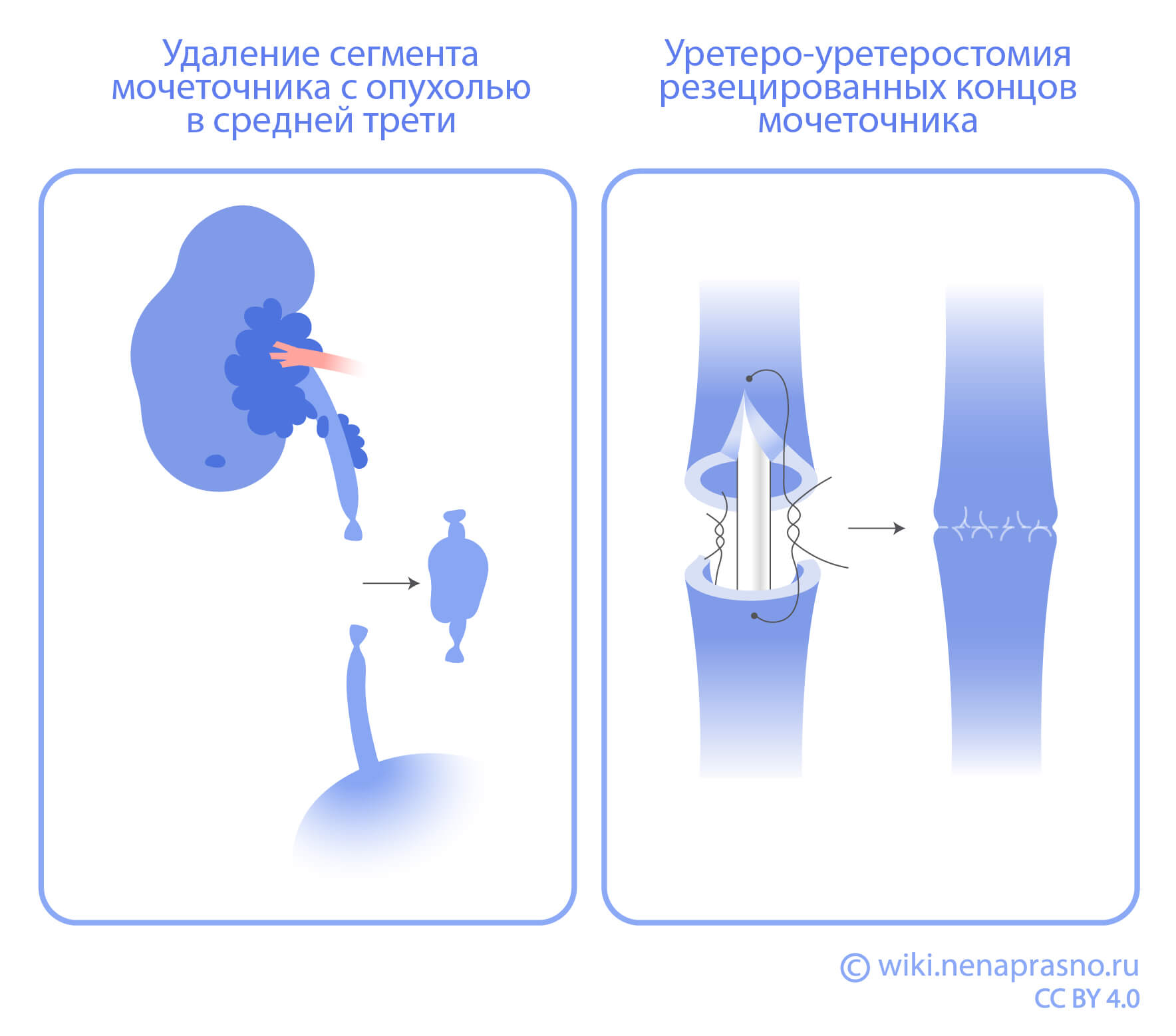 Удаление сегмента мочеточника и уретеростомия.jpg