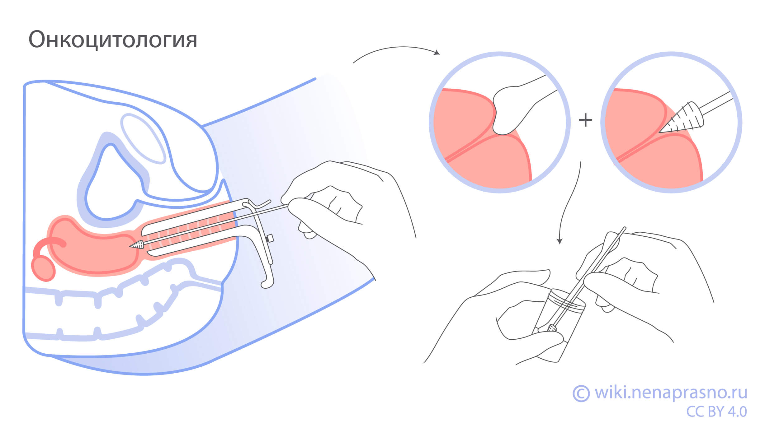 Взятие гинекологических мазков