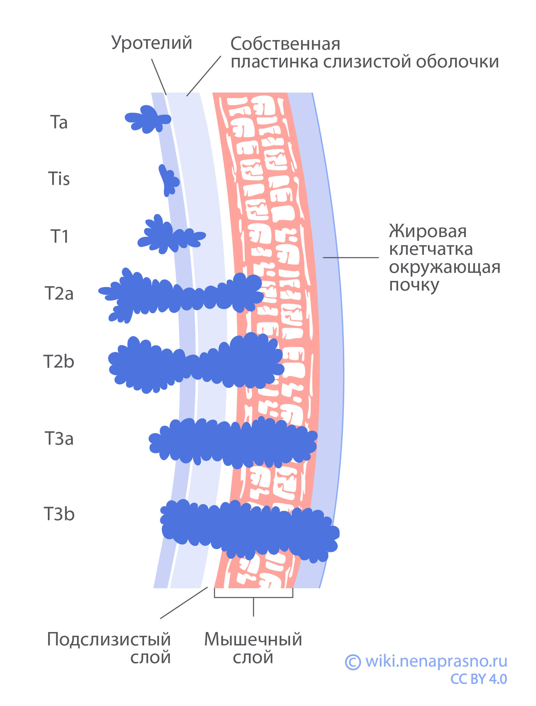 Стадии проникновения опухоли.jpg