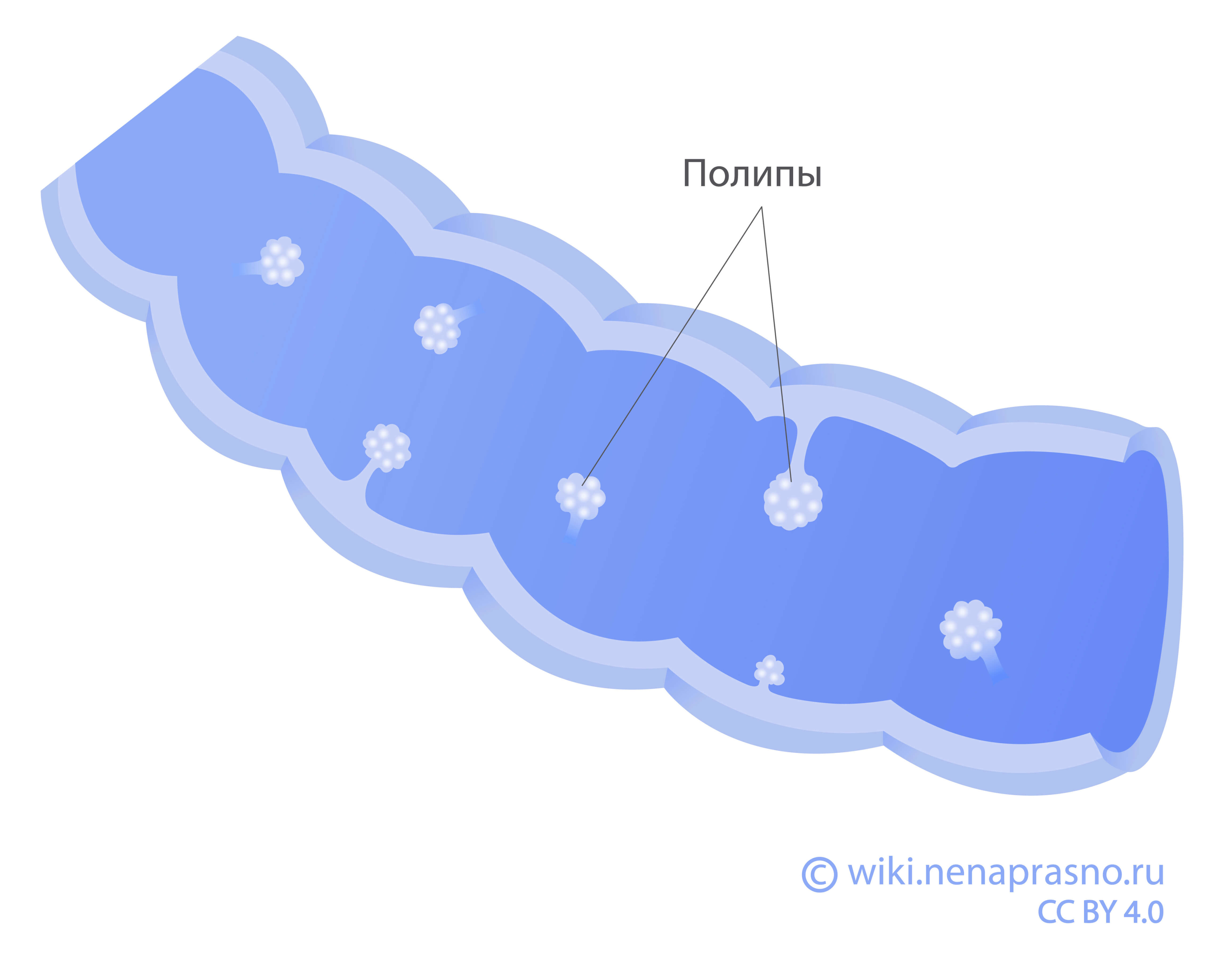 Синдром ювенильного полипоза