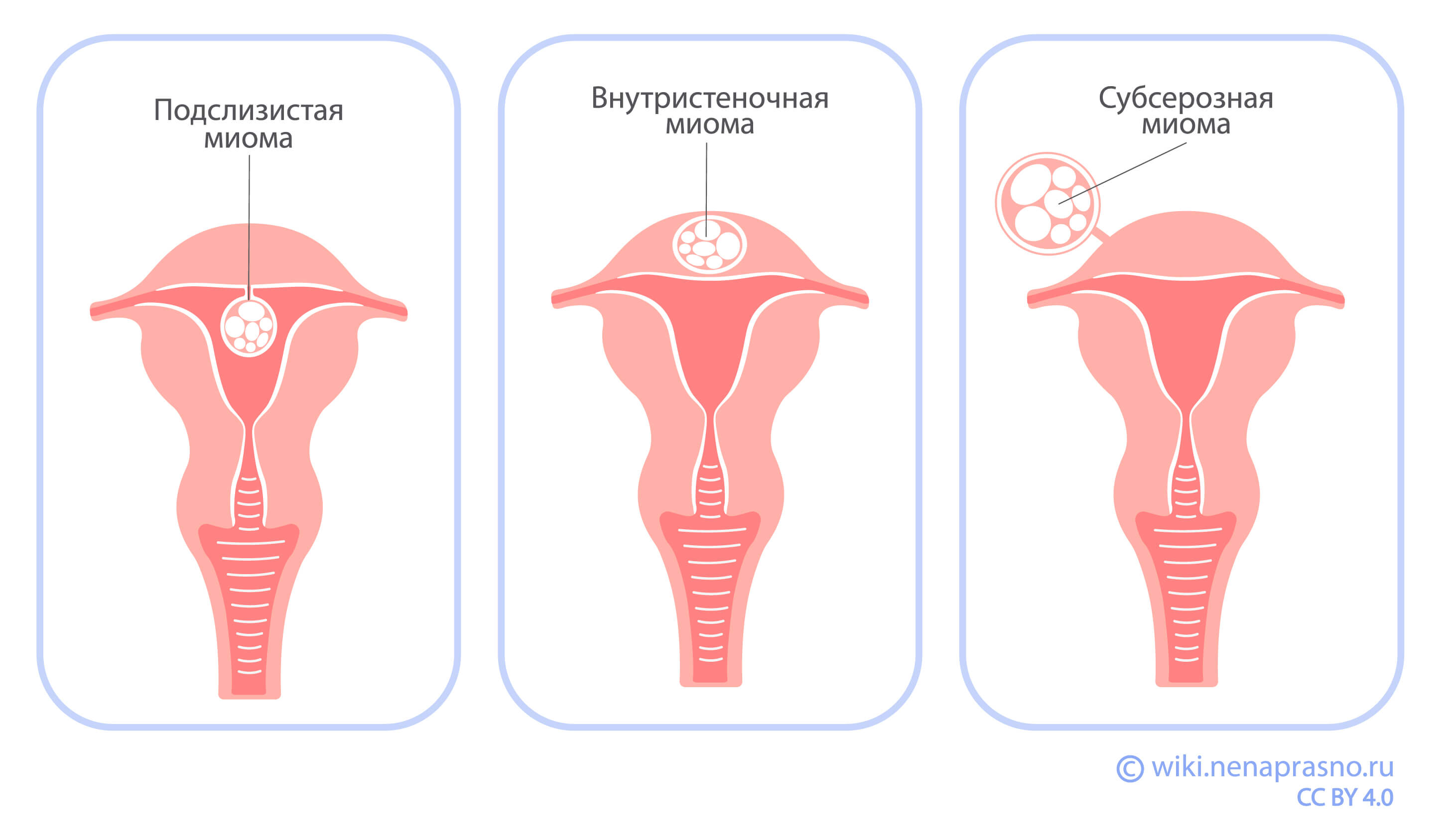 Очаговая гиперплазия эндометрия