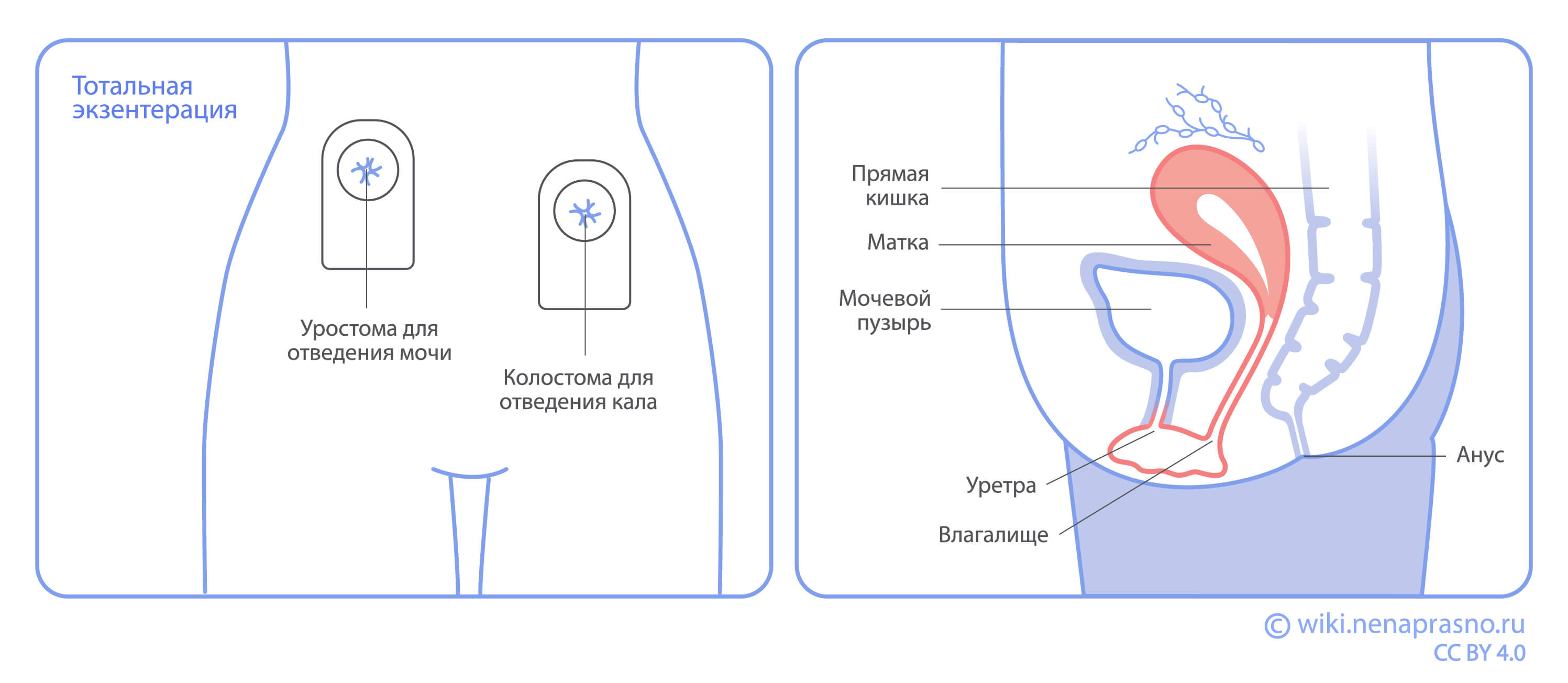 Тотальная экзентерация.jpg