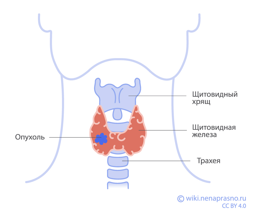 Опухоль щитовидной железы.jpg