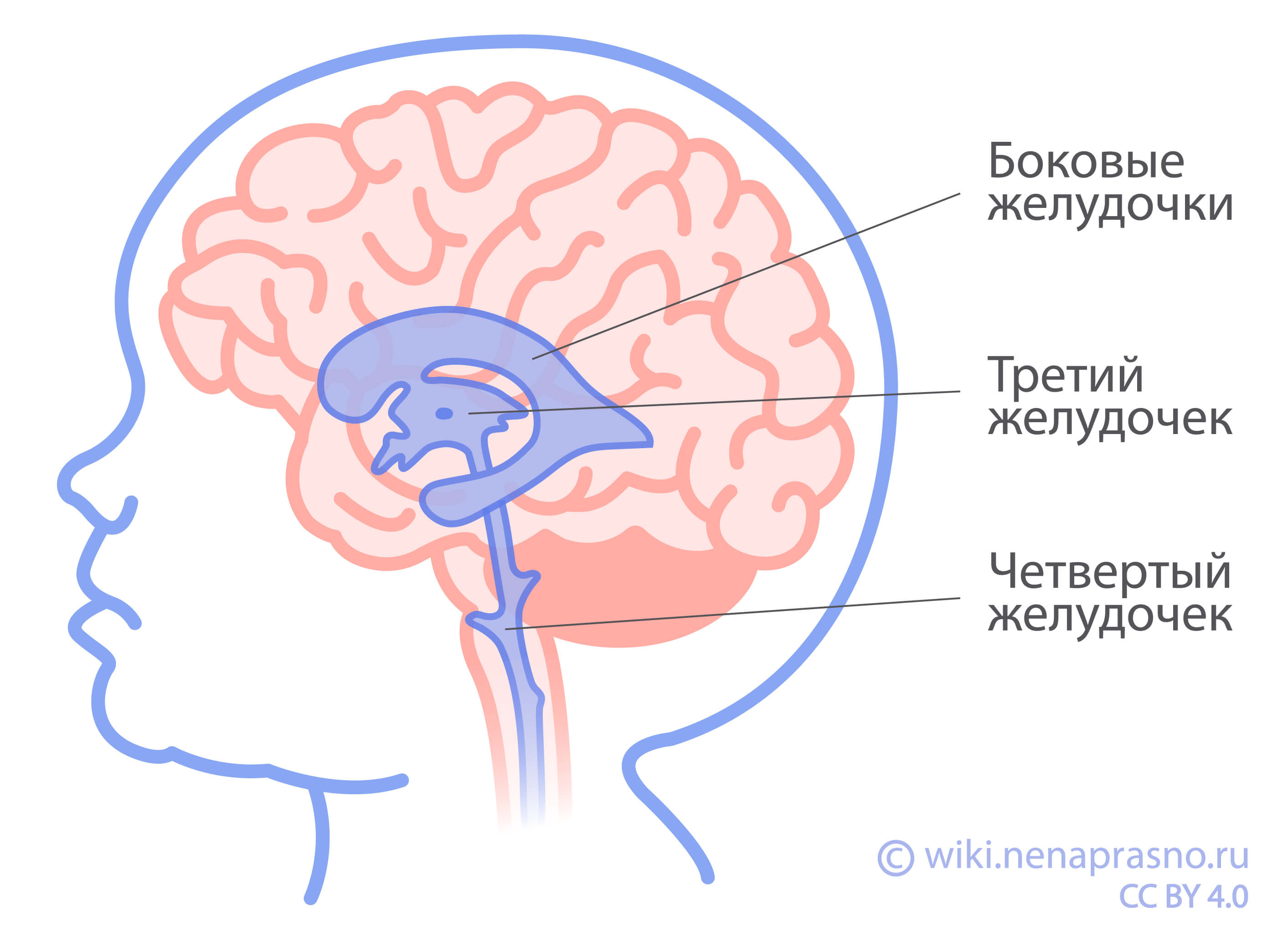 Опухоли сосудистого сплетения