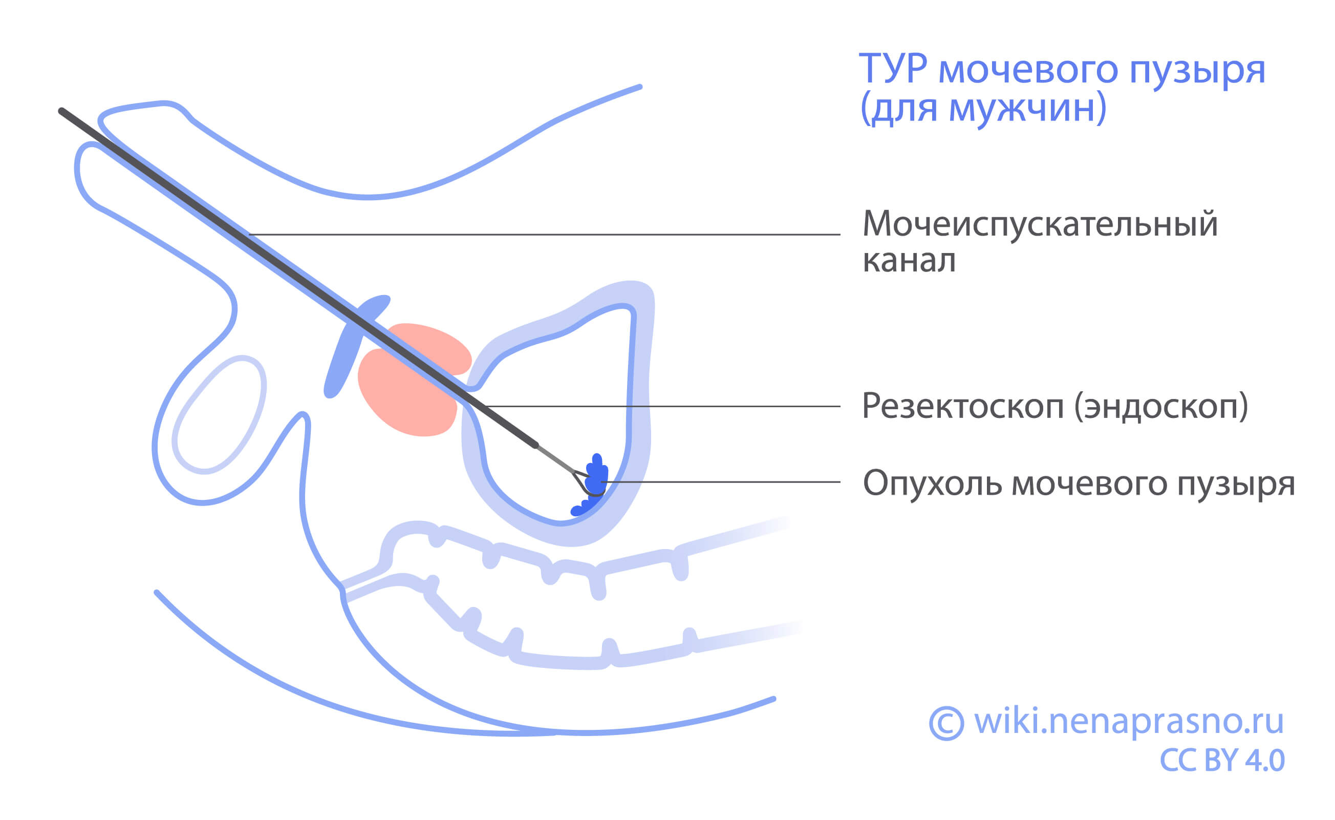 Рак мочевого пузыря – причины, признаки у женщин и мужчин, стадии, диагностика и лечение в Москве