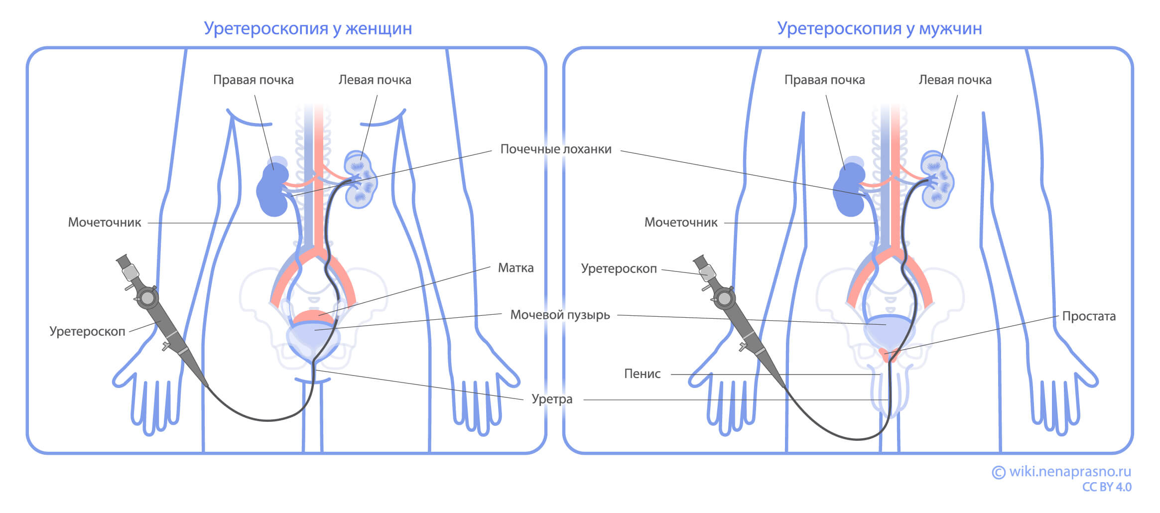 Уретероскопия_у_женщин_и_мужчин.jpg