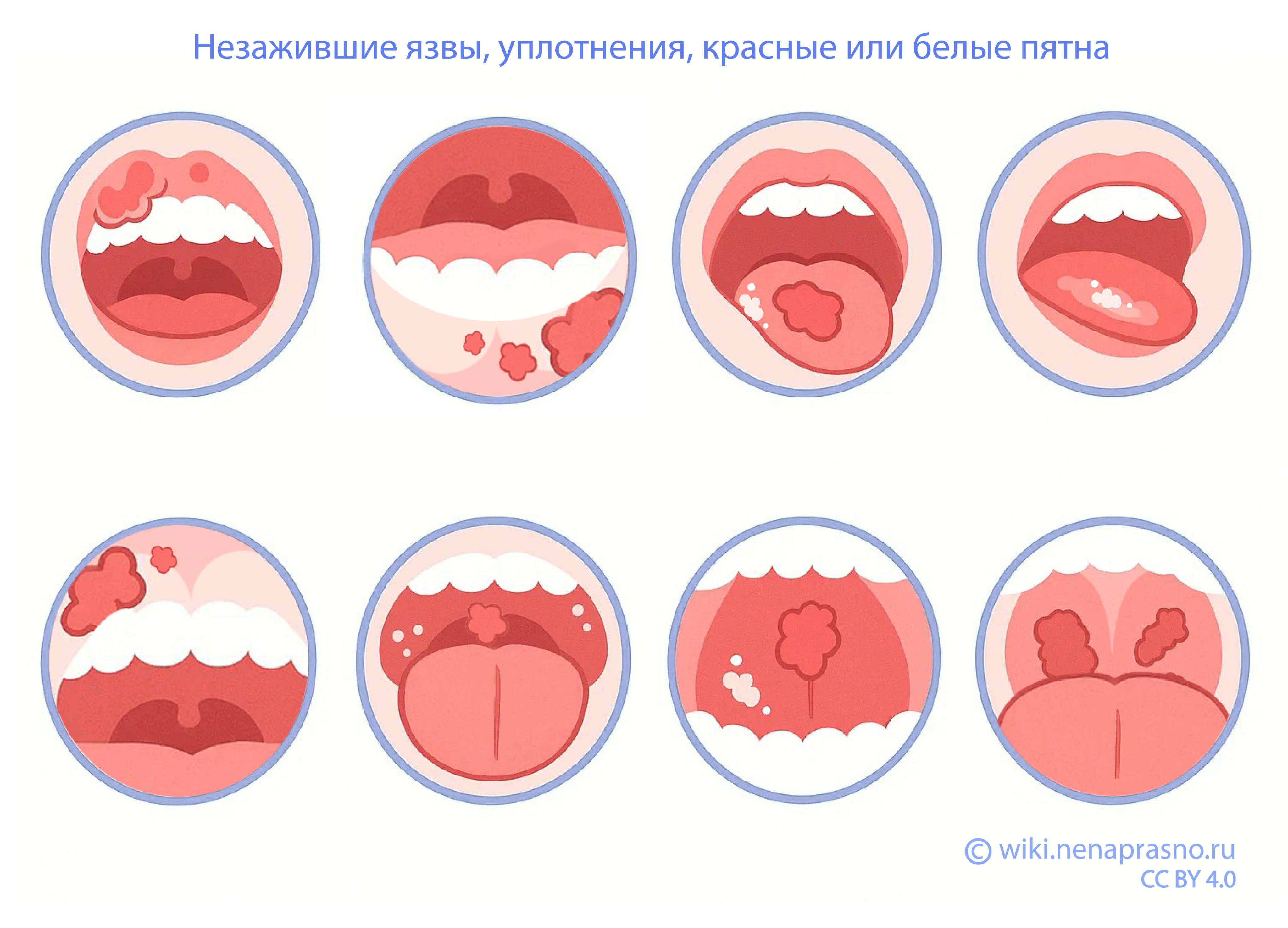 Язвы_во_рту.jpg Язвы_во_рту.jpg