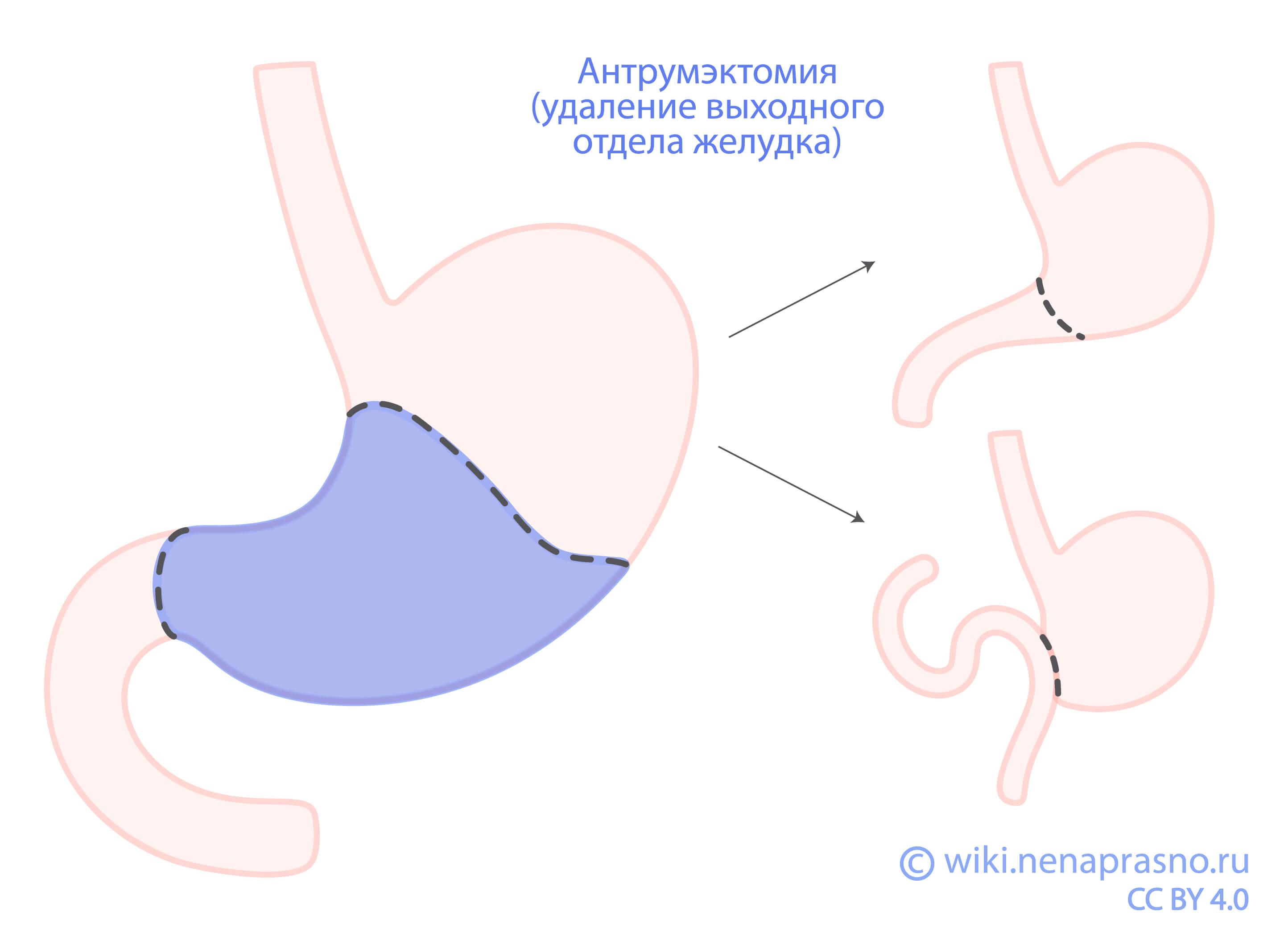 Хирургическое лечение нейроэндокринных опухолей