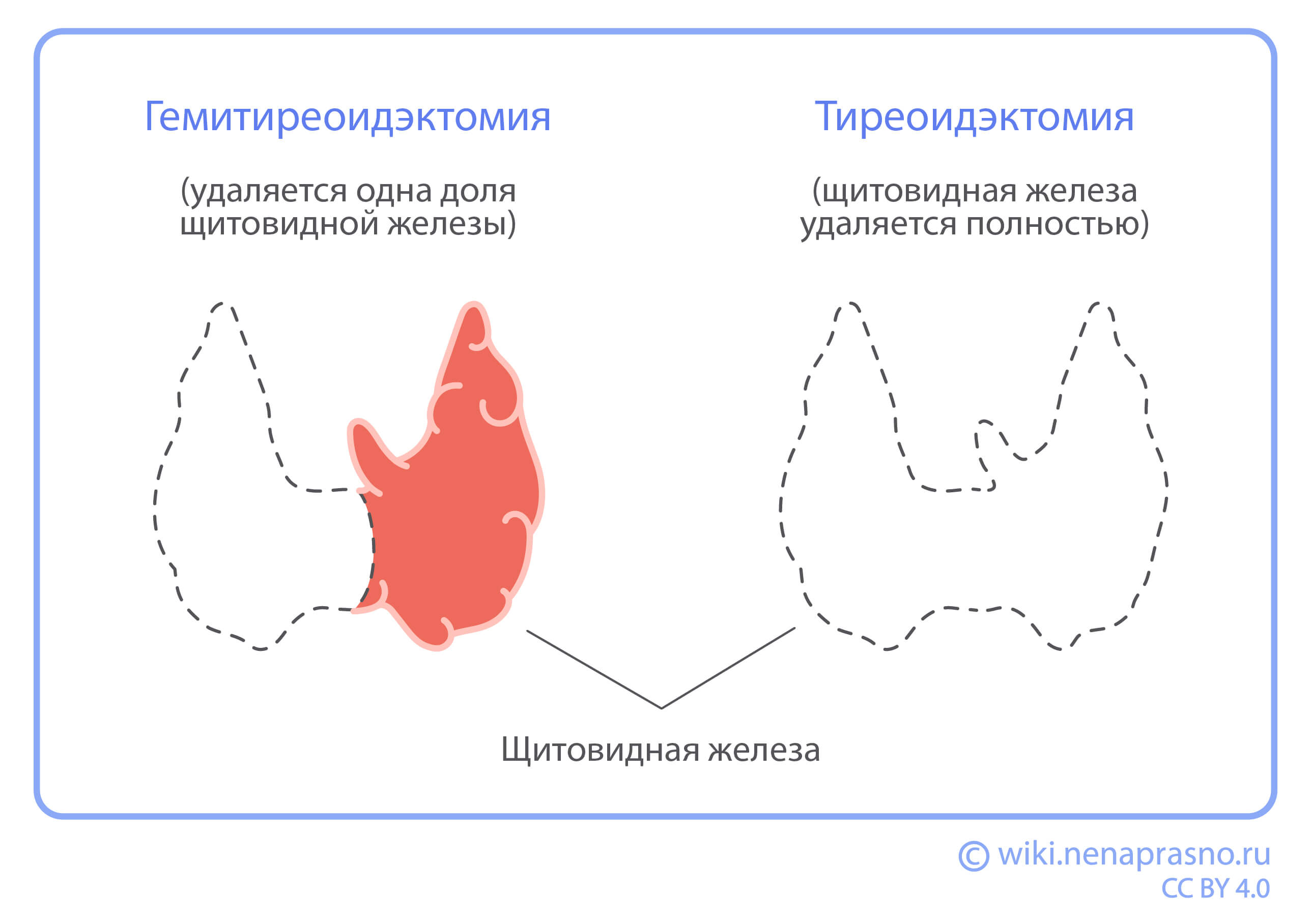 Гемитиреоидэктомия и тиреоидэктомия.jpg