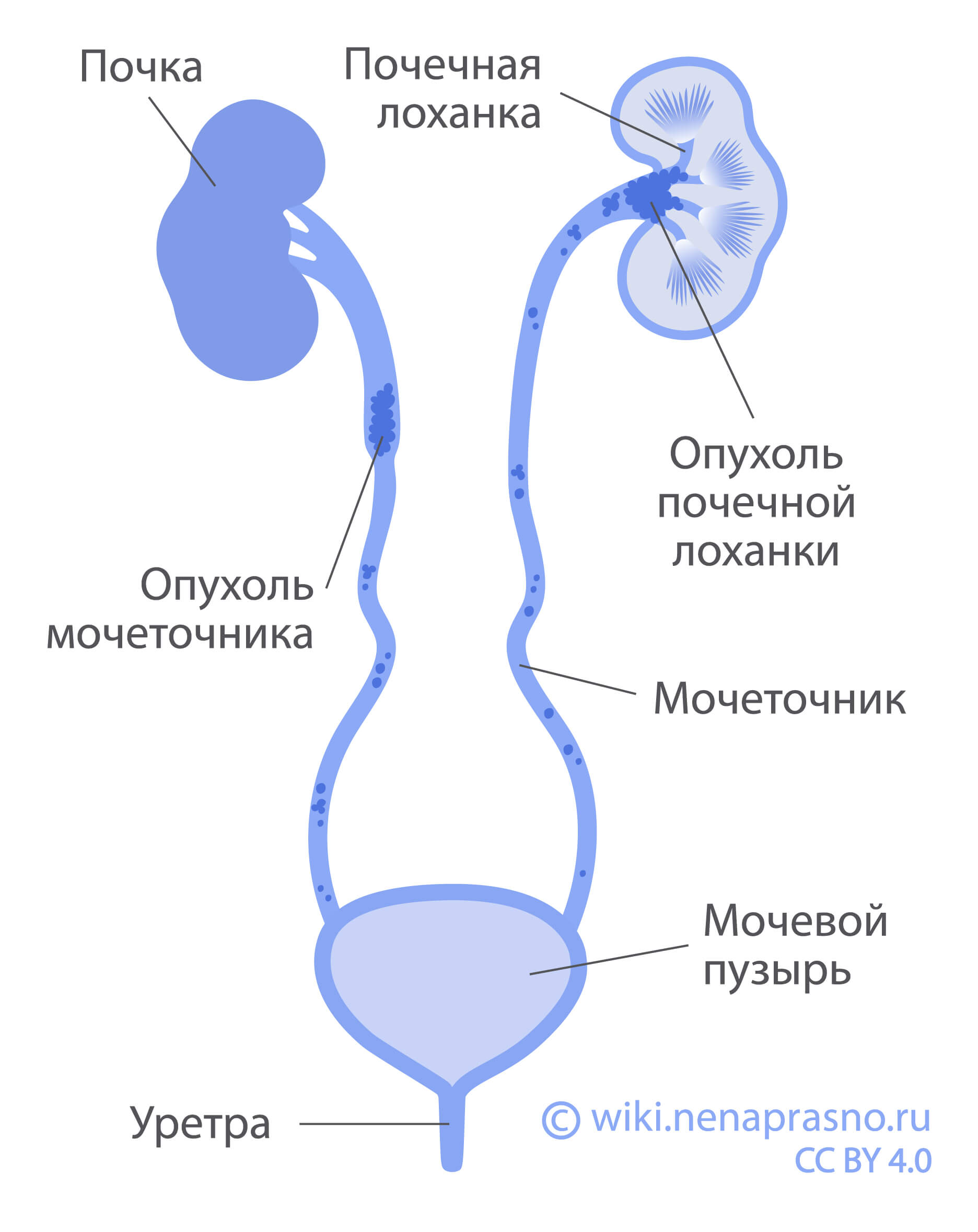 Опухоль мочеточника.jpg