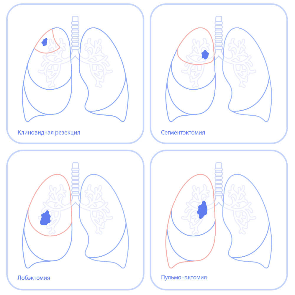 Методы хирургического лечения