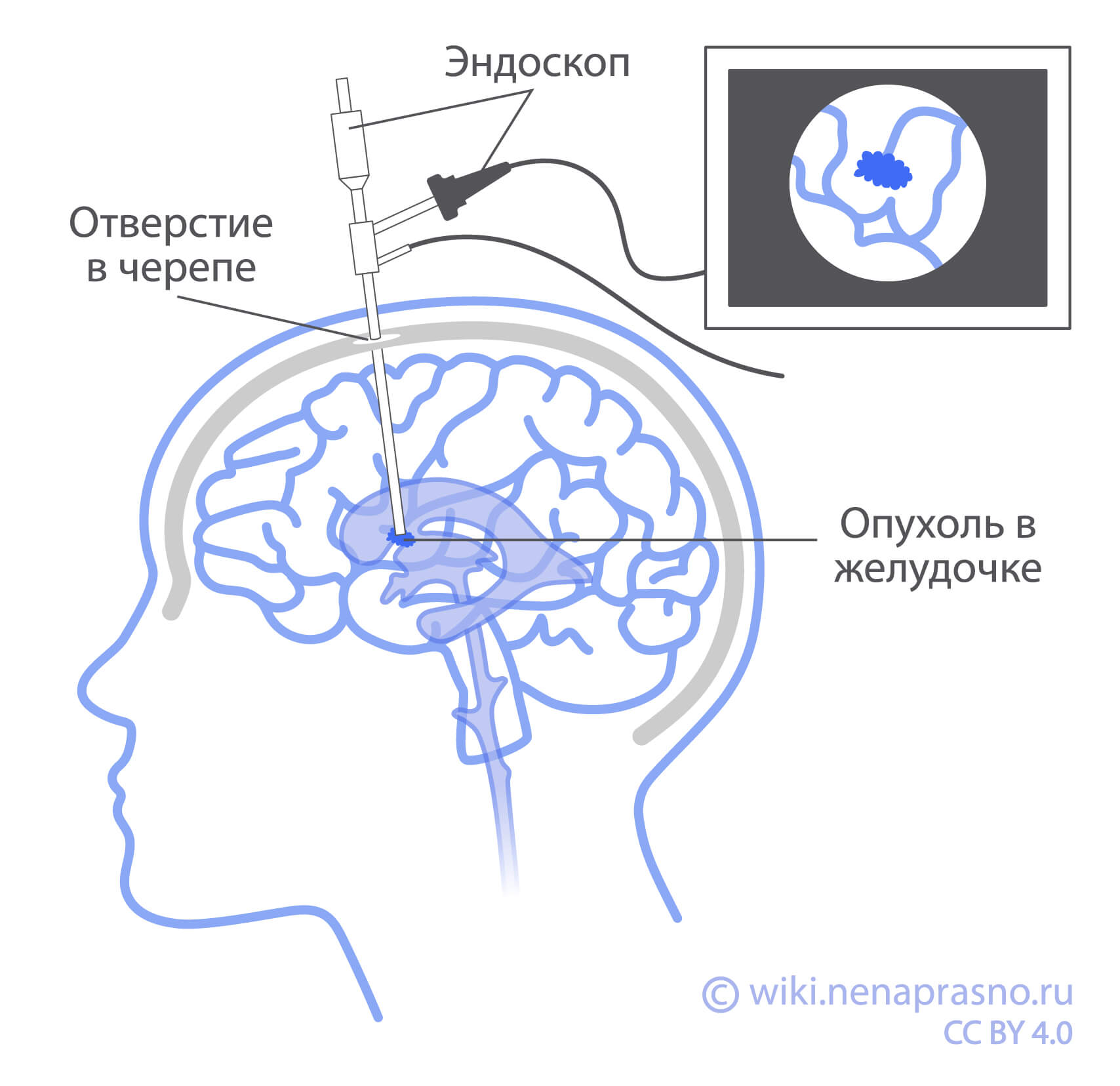 Хирургическое лечение опухолей ЦНС