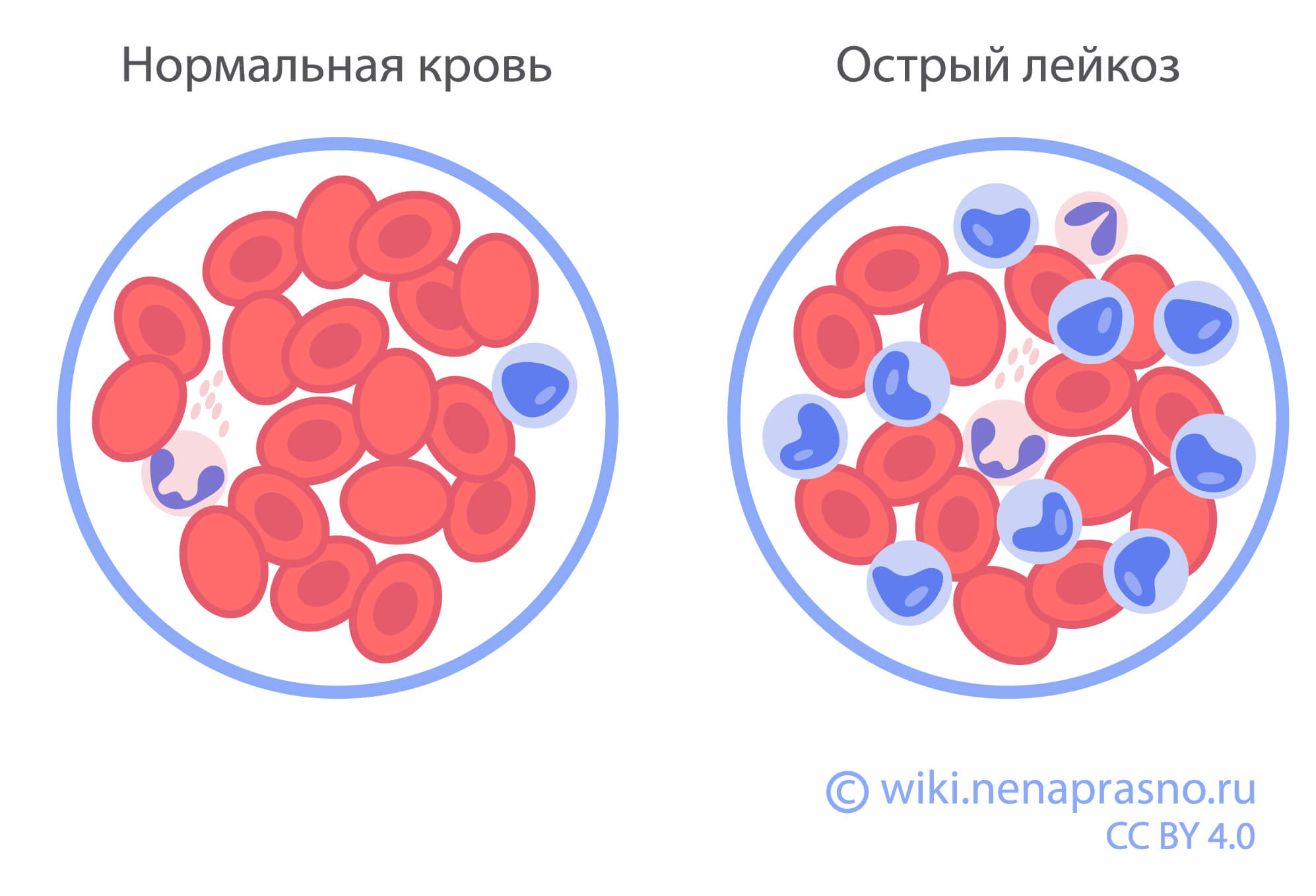 Какие бывают лейкозы? Что такое острый лейкоз?