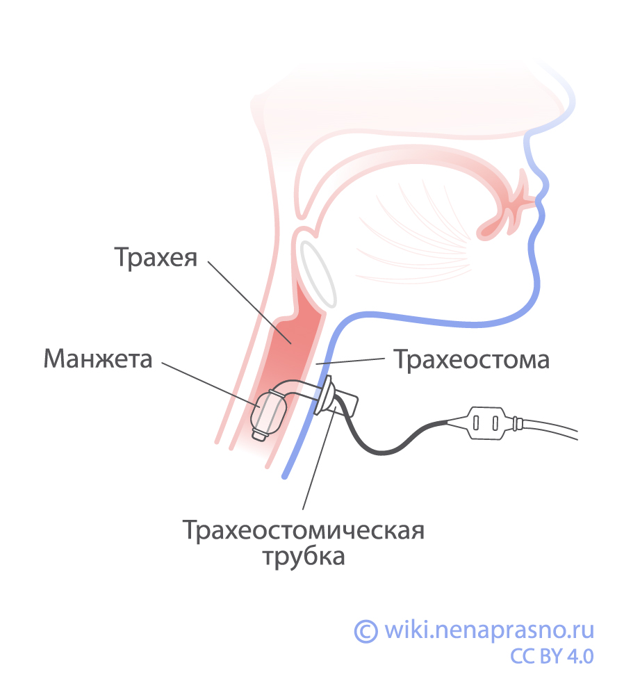 Трахеостома.jpg