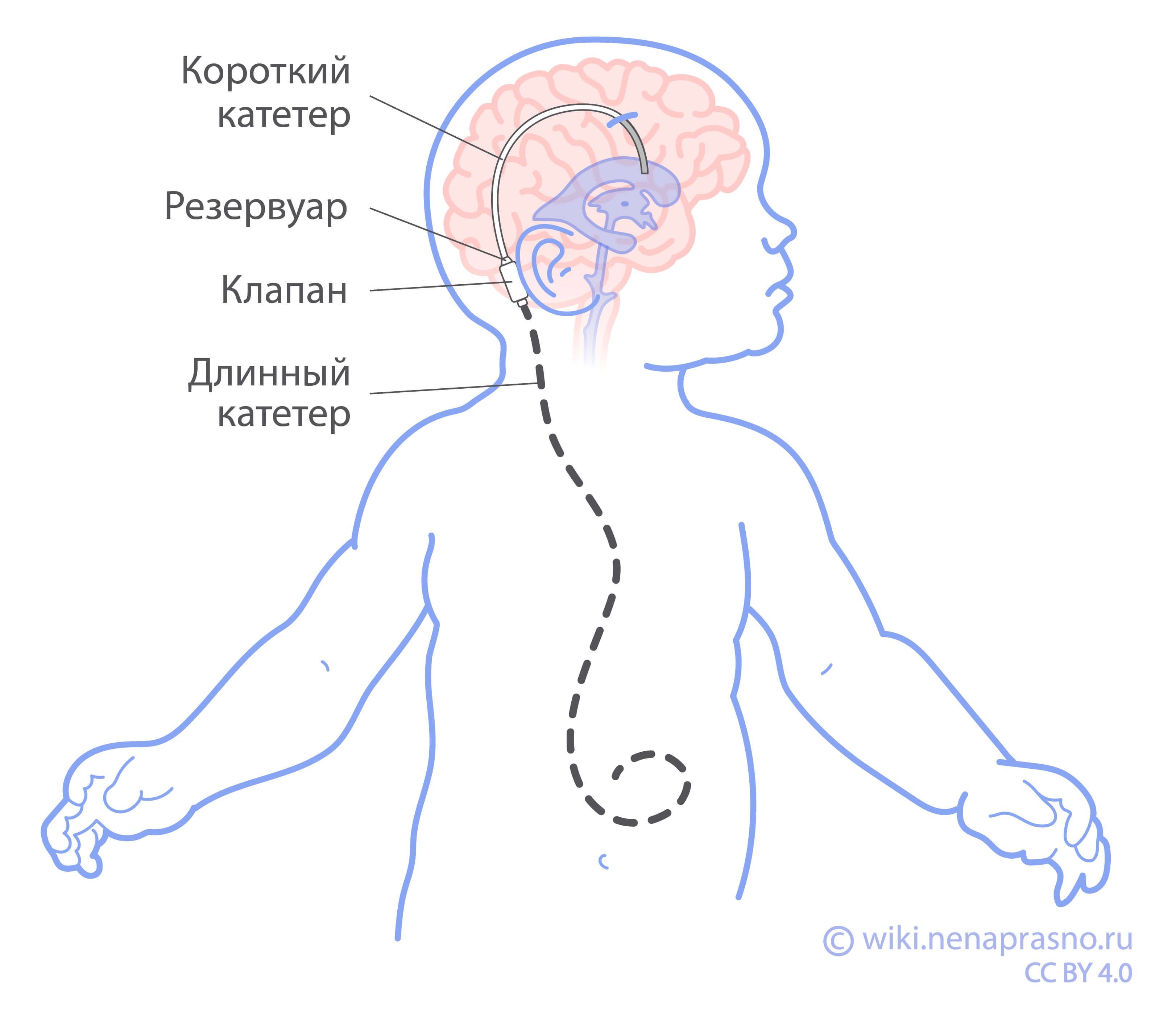 Лечение медуллобластом